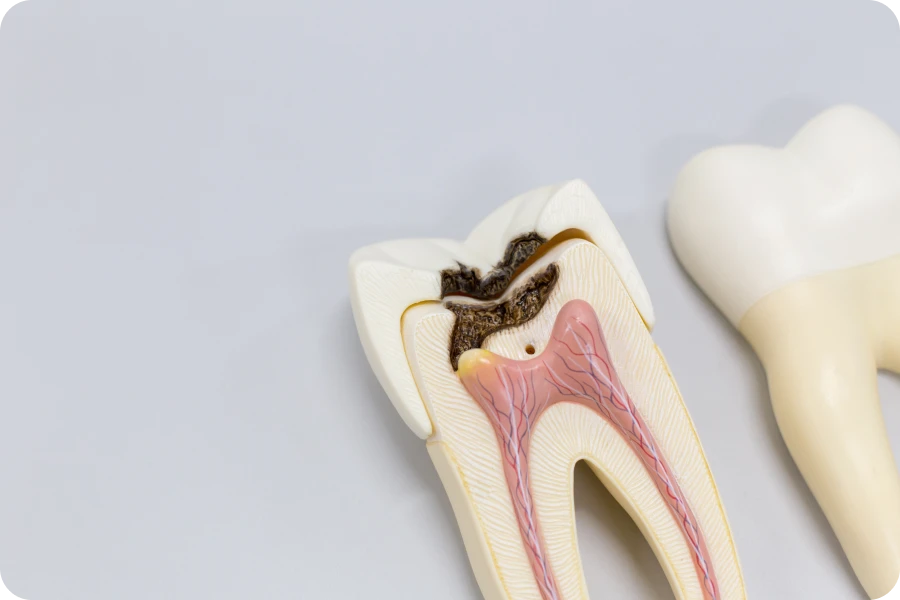 Prophylaxie, prévention des caries au cabinet dentaire des Drs Serror de Marolles en Hurepoix (91630)