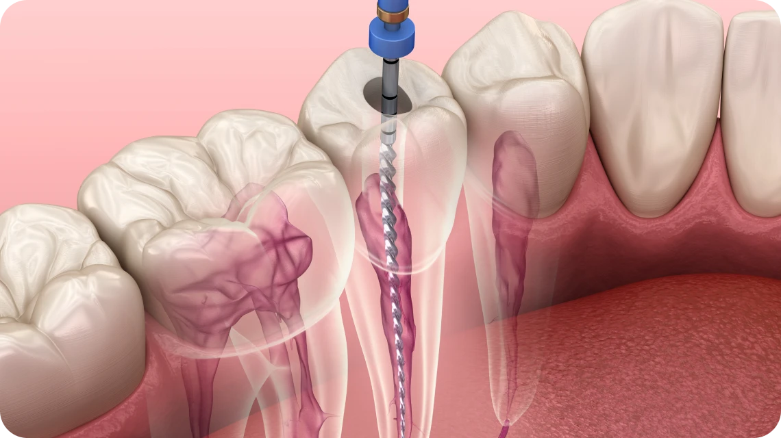 Traitements endodontie au cabinet dentaire des Drs Serror de Marolles en Hurepoix (91630)